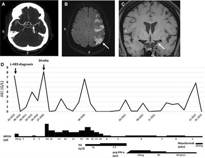 Case report: Serious unexpected vascular events in two patients with lymphocytic variant hypereosinophilic syndrome